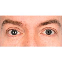 Lower Blepharoplasty Before & After Patient #2386