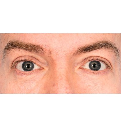 Lower Blepharoplasty Before & After Patient #2386