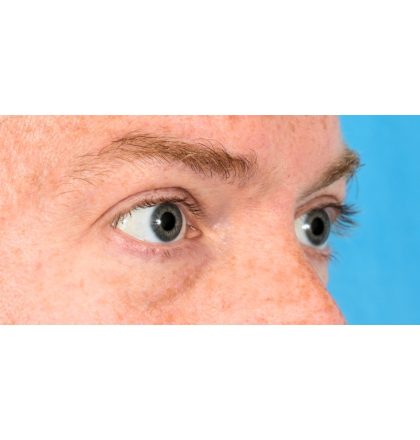 Lower Blepharoplasty Before & After Patient #2386