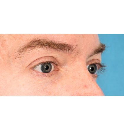 Lower Blepharoplasty Before & After Patient #2386