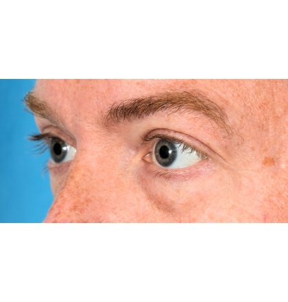 Lower Blepharoplasty Before & After Patient #2386