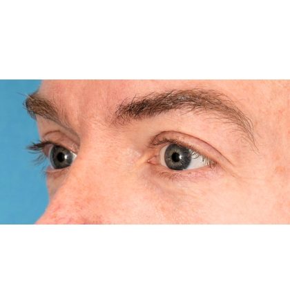 Lower Blepharoplasty Before & After Patient #2386