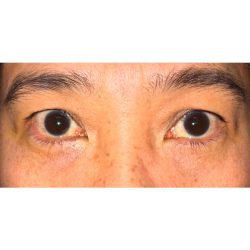 Retraction Repair Before & After Patient #2468