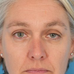 Ptosis Repair Before & After Patient #2405