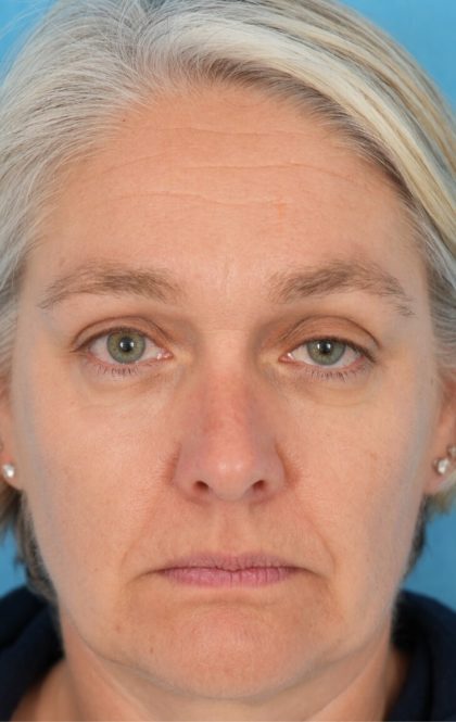 Ptosis Repair Before & After Patient #2405