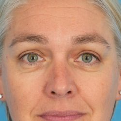 Ptosis Repair Before & After Patient #2405
