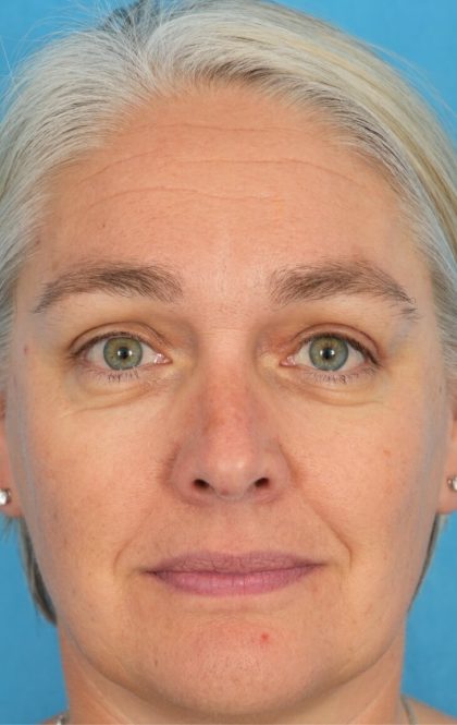 Ptosis Repair Before & After Patient #2405