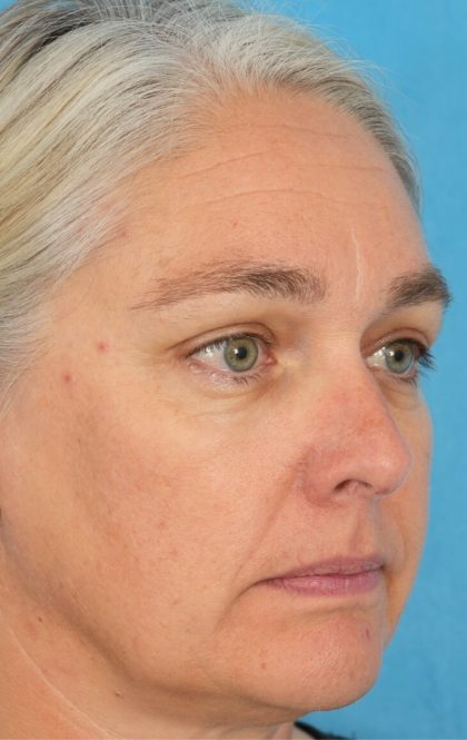 Ptosis Repair Before & After Patient #2405