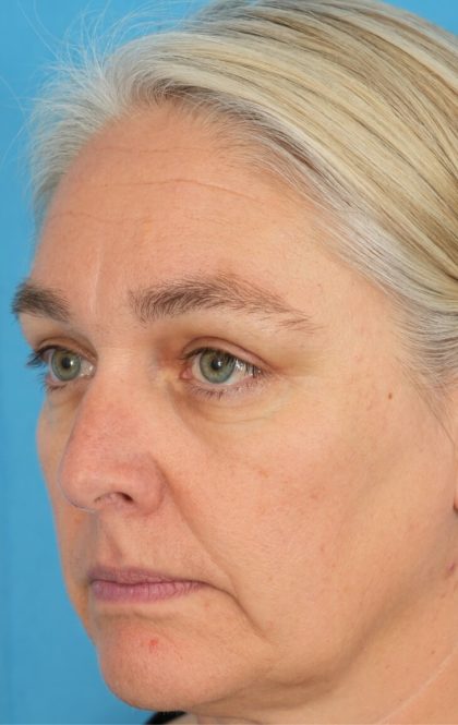 Ptosis Repair Before & After Patient #2405