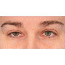 Ptosis Repair Before & After Patient #2406