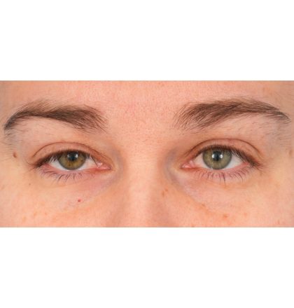 Ptosis Repair Before & After Patient #2406