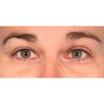 Ptosis Repair Before & After Patient #2406