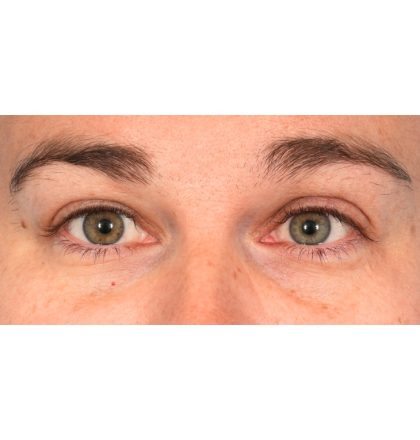 Ptosis Repair Before & After Patient #2406