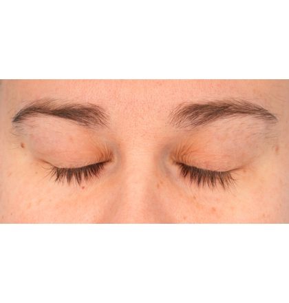 Ptosis Repair Before & After Patient #2406