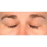 Ptosis Repair Before & After Patient #2406