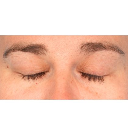 Ptosis Repair Before & After Patient #2406