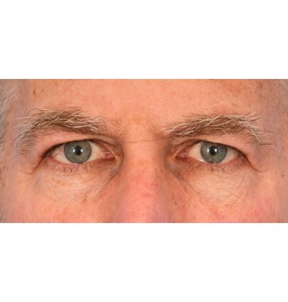 Upper Blepharoplasty Before & After Patient #2359