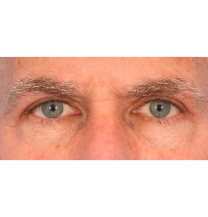 Upper Blepharoplasty Before & After Patient #2359