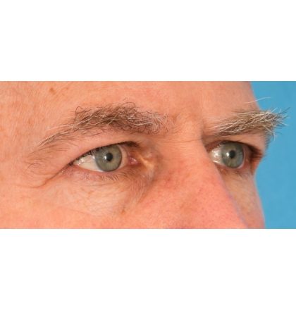 Upper Blepharoplasty Before & After Patient #2359