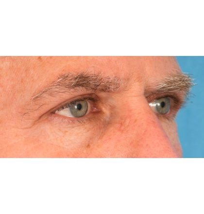 Upper Blepharoplasty Before & After Patient #2359