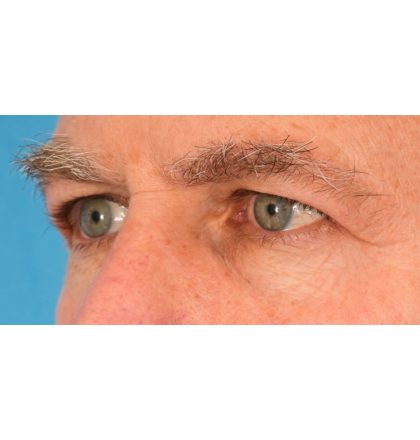 Upper Blepharoplasty Before & After Patient #2359