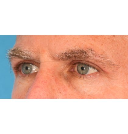 Upper Blepharoplasty Before & After Patient #2359