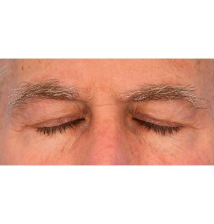 Upper Blepharoplasty Before & After Patient #2359