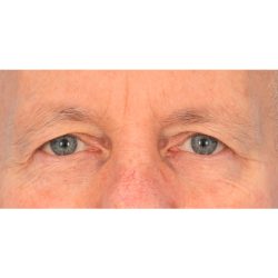 Upper Blepharoplasty Before & After Patient #2368