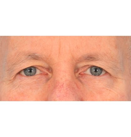 Upper Blepharoplasty Before & After Patient #2368