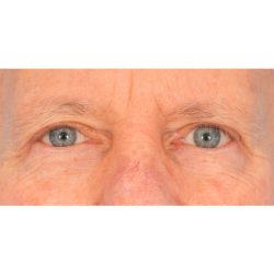 Upper Blepharoplasty Before & After Patient #2368