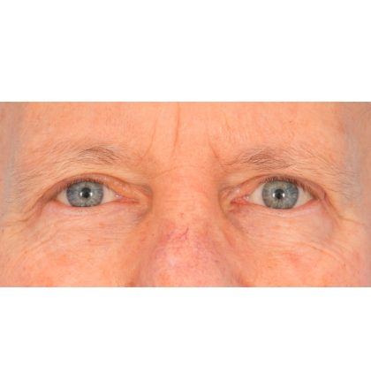 Upper Blepharoplasty Before & After Patient #2368