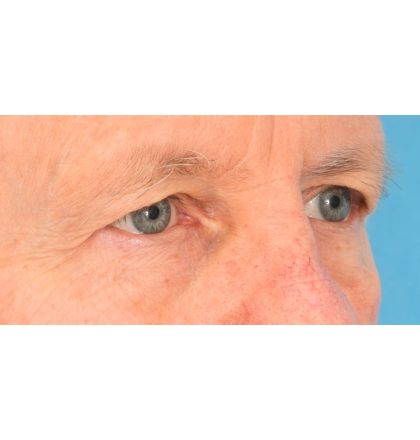 Upper Blepharoplasty Before & After Patient #2368