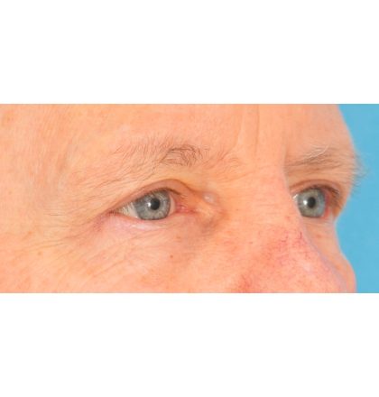 Upper Blepharoplasty Before & After Patient #2368