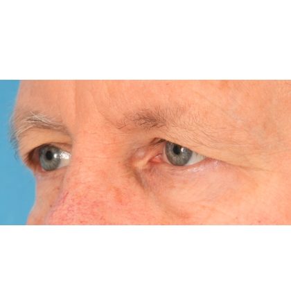 Upper Blepharoplasty Before & After Patient #2368