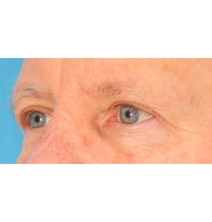 Upper Blepharoplasty Before & After Patient #2368