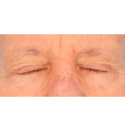 Upper Blepharoplasty Before & After Patient #2368