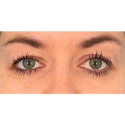 Upper Blepharoplasty Before & After Patient #2377