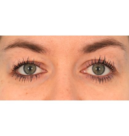 Upper Blepharoplasty Before & After Patient #2377