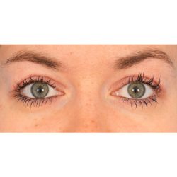 Upper Blepharoplasty Before & After Patient #2377