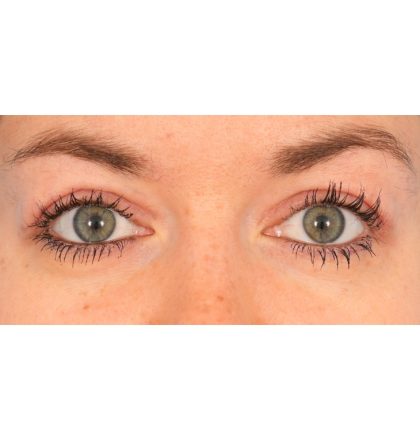 Upper Blepharoplasty Before & After Patient #2377