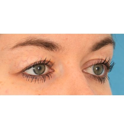 Upper Blepharoplasty Before & After Patient #2377