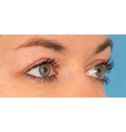 Upper Blepharoplasty Before & After Patient #2377