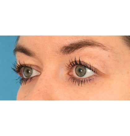 Upper Blepharoplasty Before & After Patient #2377