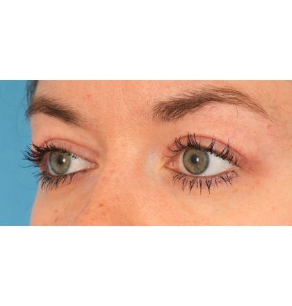 Upper Blepharoplasty Before & After Patient #2377