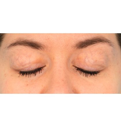 Upper Blepharoplasty Before & After Patient #2377