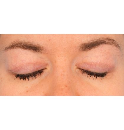 Upper Blepharoplasty Before & After Patient #2377