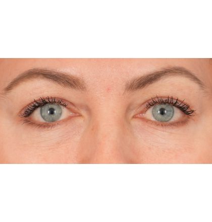 Upper Blepharoplasty Before & After Patient #2394