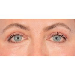 Upper Blepharoplasty Before & After Patient #2394
