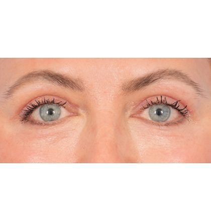 Upper Blepharoplasty Before & After Patient #2394