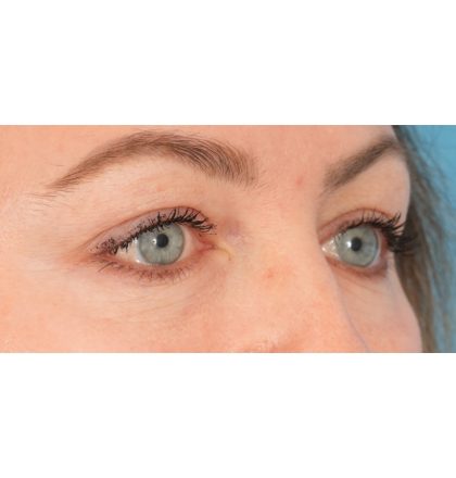 Upper Blepharoplasty Before & After Patient #2394